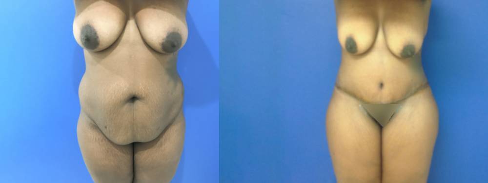 Tummy Tuck Before and After in  Miami