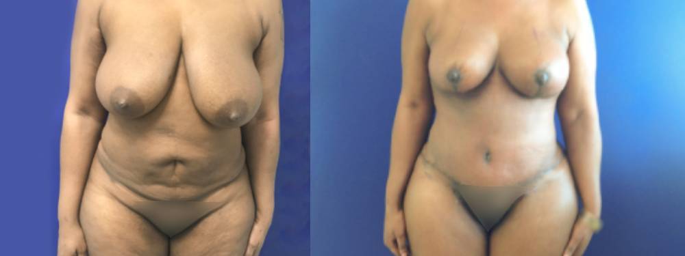 Mommy Makeover Before and After in Miami