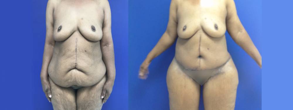 Tummy Tuck Before and After