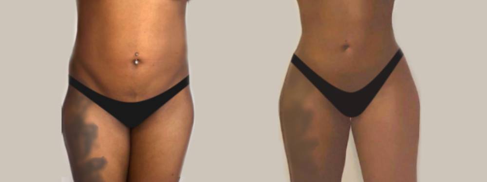 Liposuction Before and After in Miami