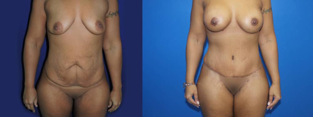 Tummy Tuck Before and After in Miami