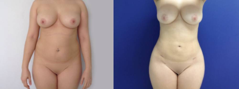 Liposuction Before and After 