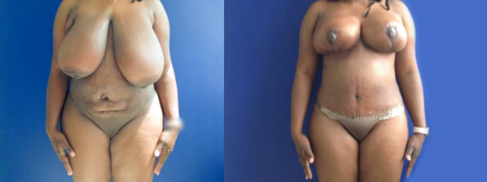 Mommy Makeover Before and after in Miami