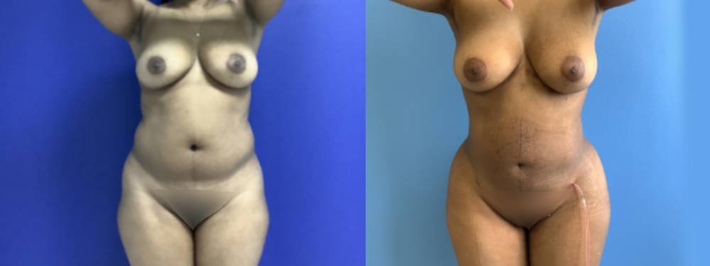 Liposuction Before and After