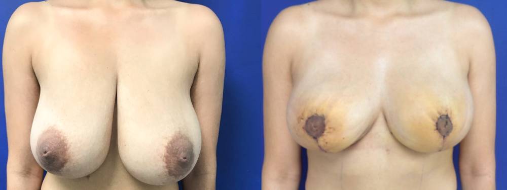 Breast Lift Before and After in Miami
