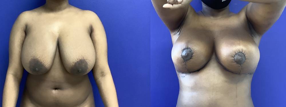 Breast Lift Before and After in Miami