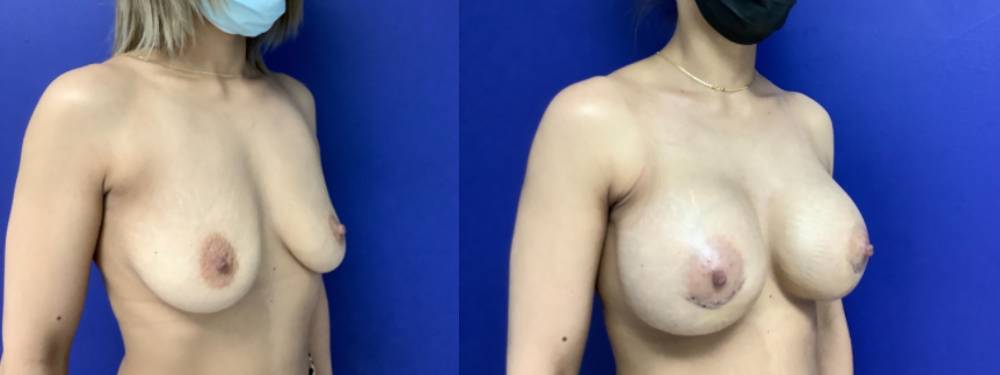 Breast Augmentation Before and After in miami