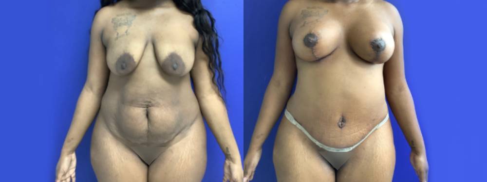 Mommy Makeover Before and After in Miami