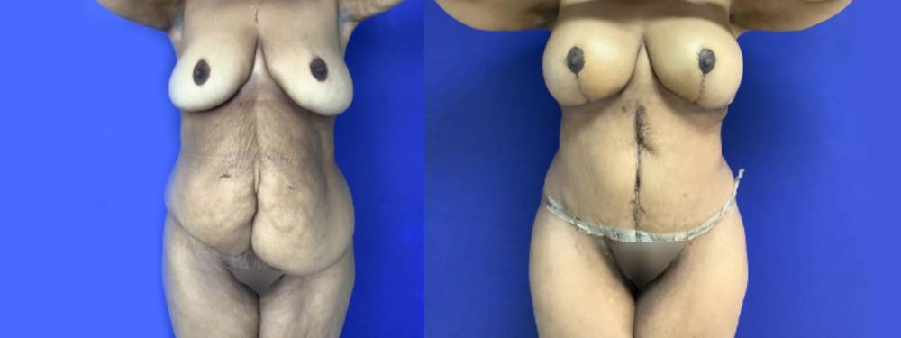 Mommy Makeover Before and After in Miami