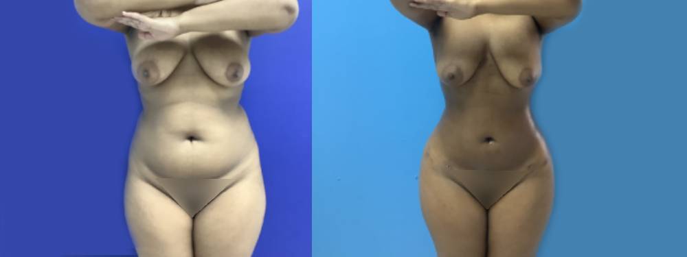 Liposuction Before and After in Miami