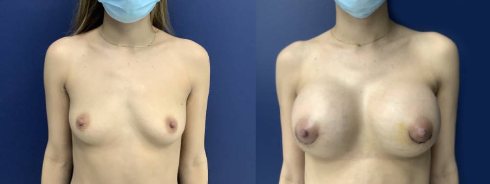 Breast Augmentation Before and After in Miami