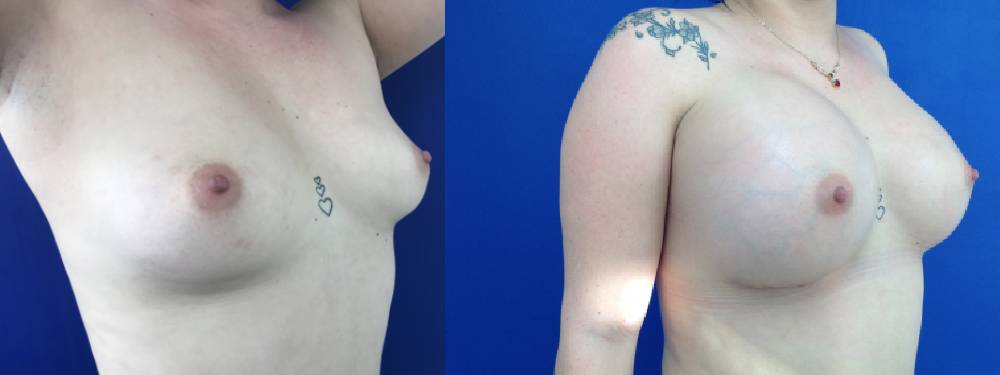 Breast Augmentation Before and after in Miami