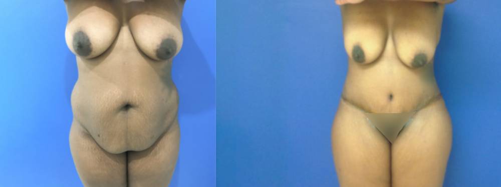 Tummy Tuck Before and After in Miami
