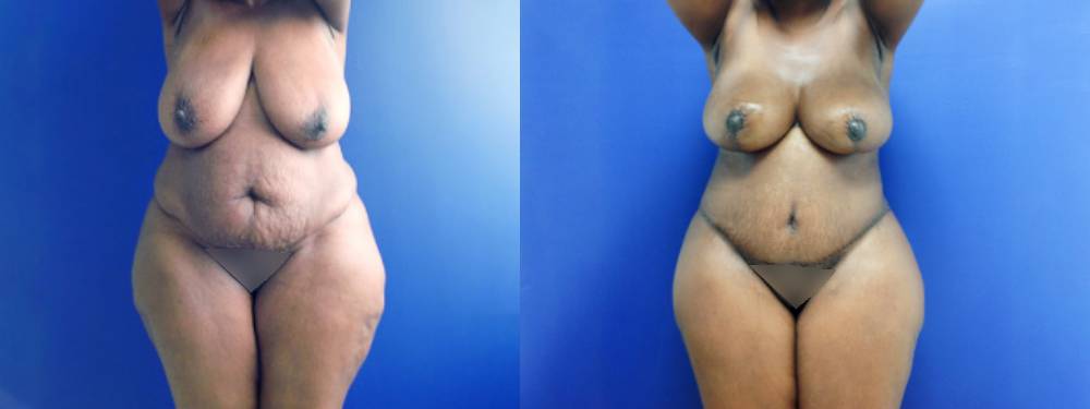 Mommy Makeover Before and After 