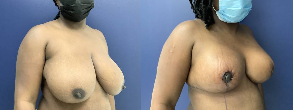 Breast Lift Before and After in Miami