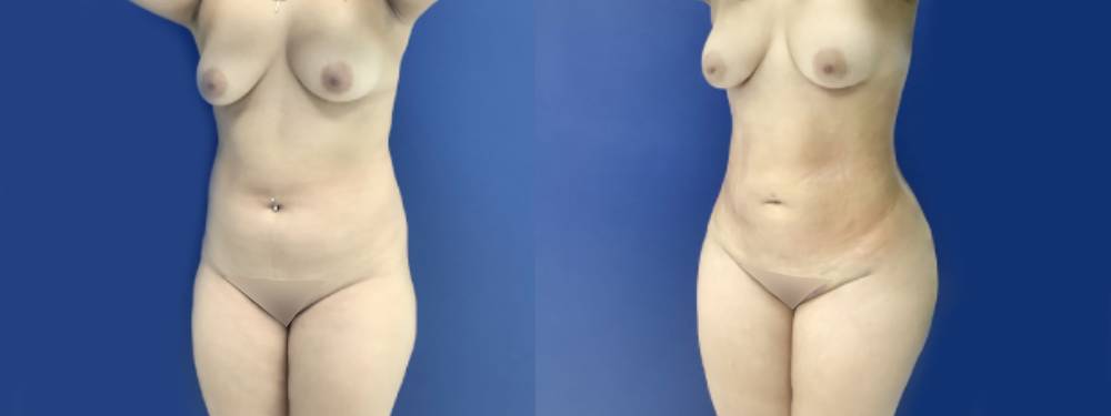 Liposuction Before and After
