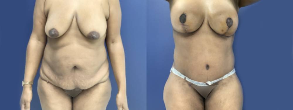 Mommy Makeover Before and After 