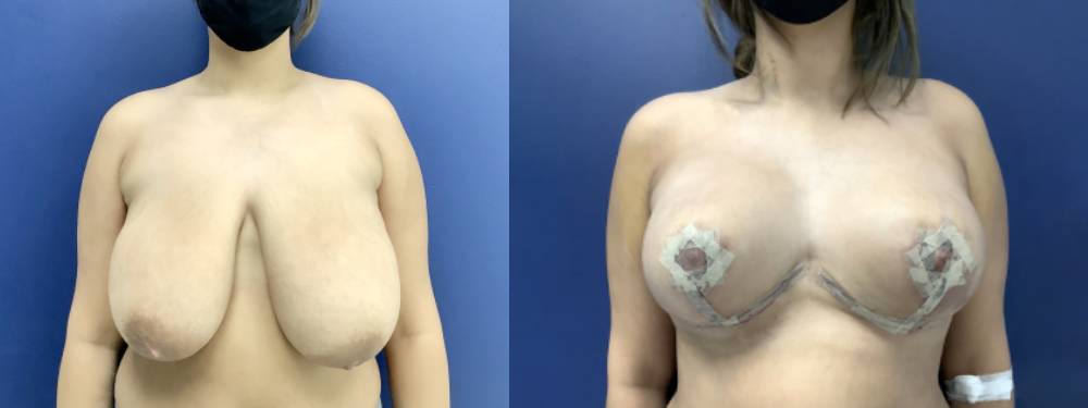 Breast Lift Before and After in Miami