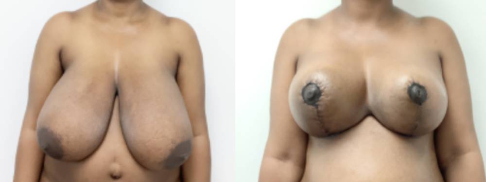 Breast Lift Before and After in Miami