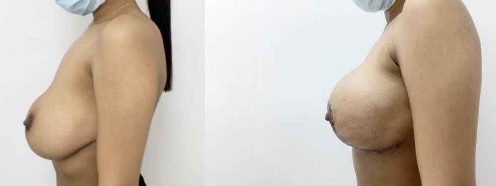 Breast Lift Before and After