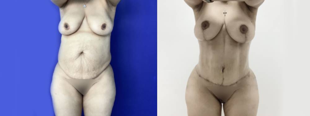 Mommy Makeover Before and After