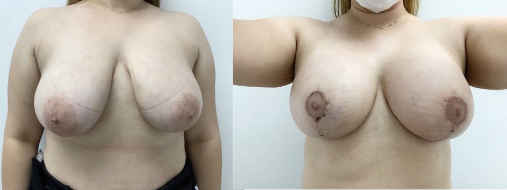 Breast Lift Before and After in Miami