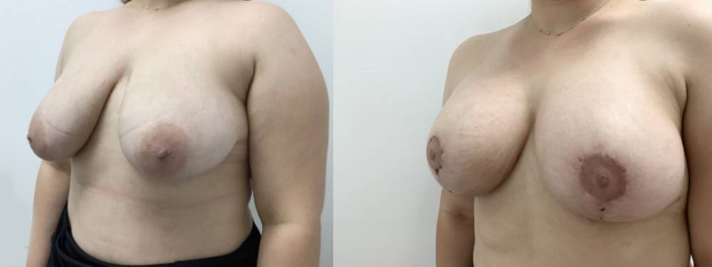 Breast Lift Before and After 