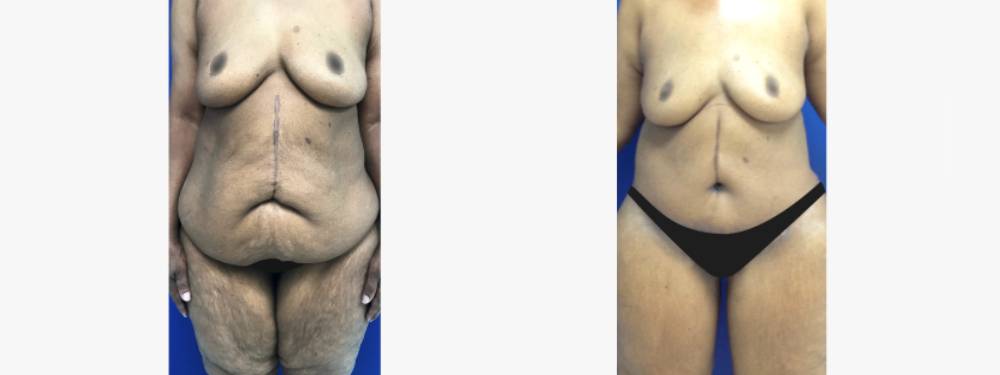 Liposuction Before and After in Miami