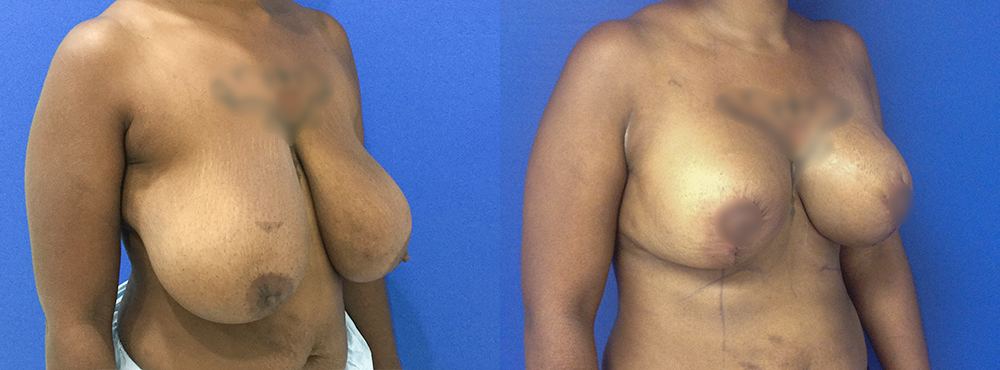 Breast Reduction Before and After in Miami