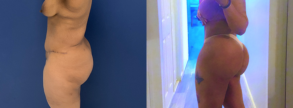 Brazilian Butt Lift Before and After in miami