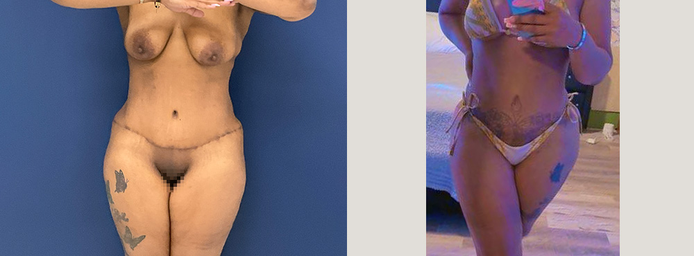 Lipo 360 Before and After In Miami