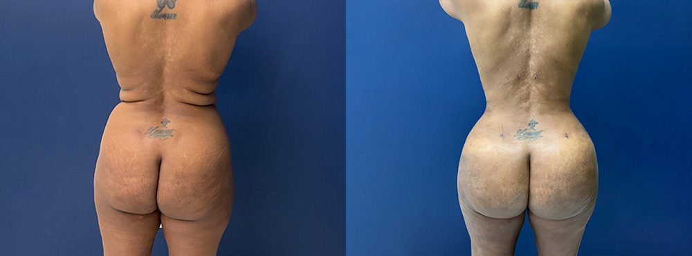 Combo BBL and Tummy Tuck before and after