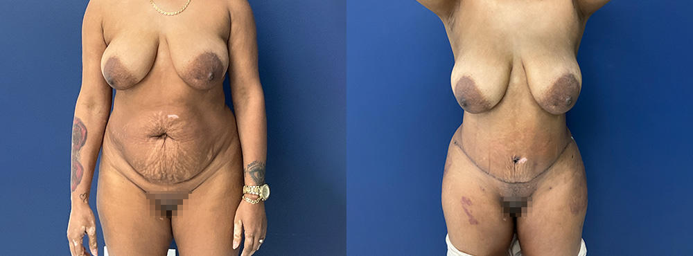 Combo BBL and Tummy Tuck before and after