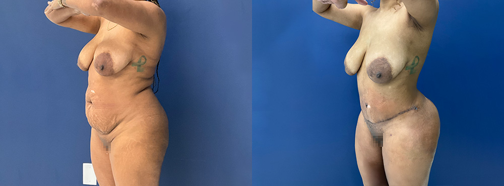 Combo BBL and Tummy Tuck before and after