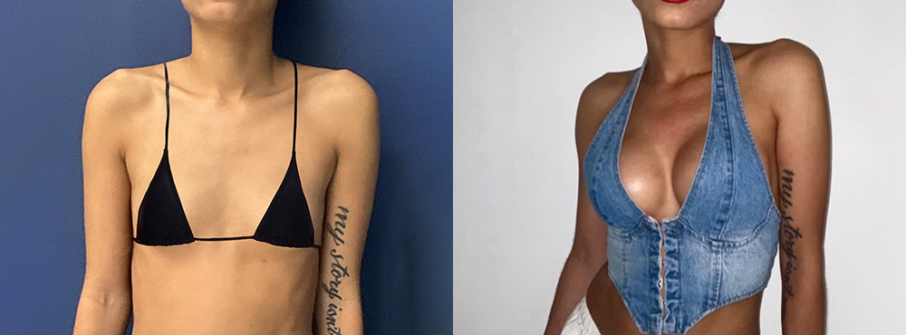 Breast Augmentation before after