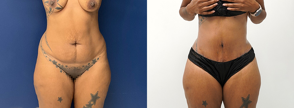 Abdominoplasty before and after
