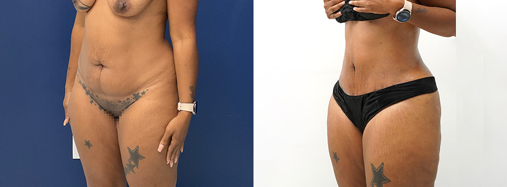 Abdominoplasty before and after