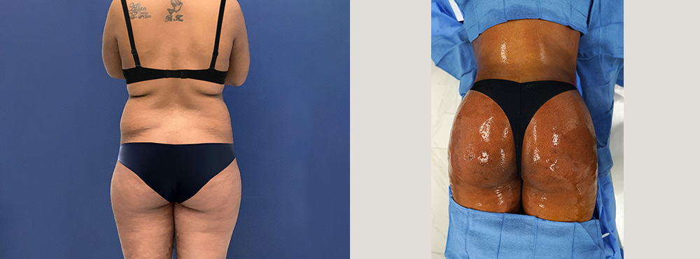 Brazilian Butt Lift Before and After