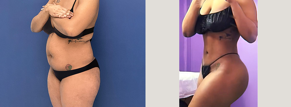 Brazilian Butt Lift Before and After