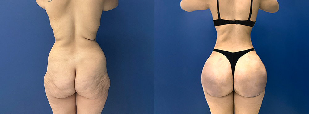 Brazilian Butt Lift Miami Before After