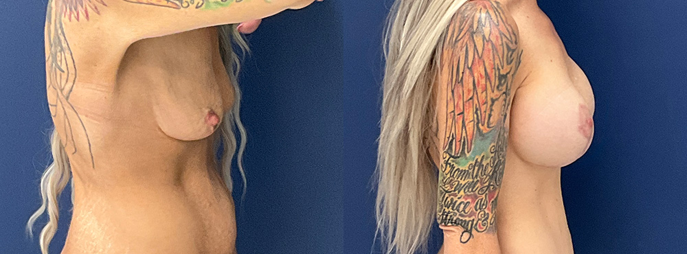 Breast Lift Before and After