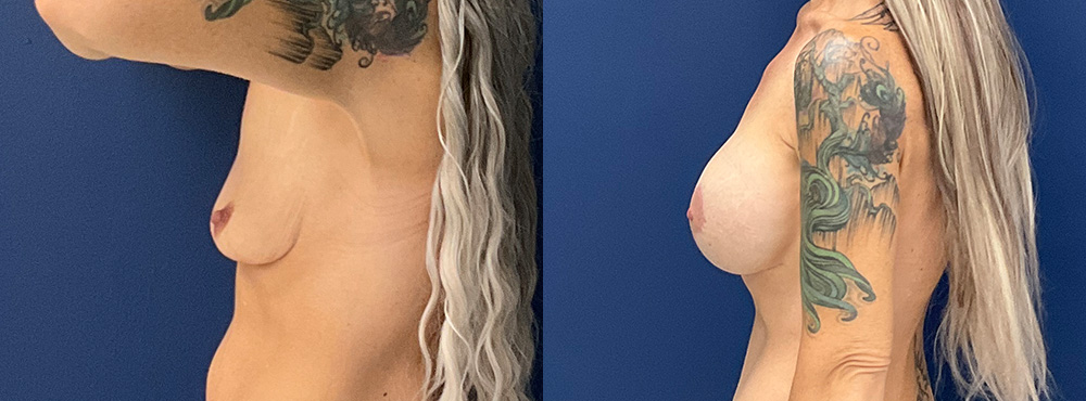 Breast Lift Before and After