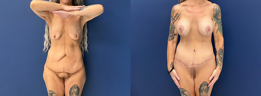 Mommy Makeover Before and After in miami