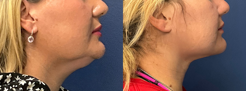 Chin Lipo Before and After in miami