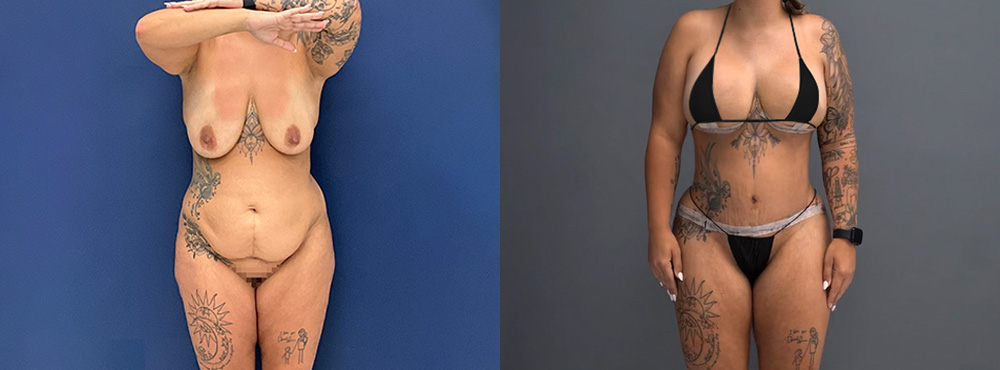 Mommy Makeover before and after