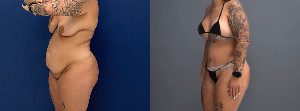 Mommy Makeover before and after