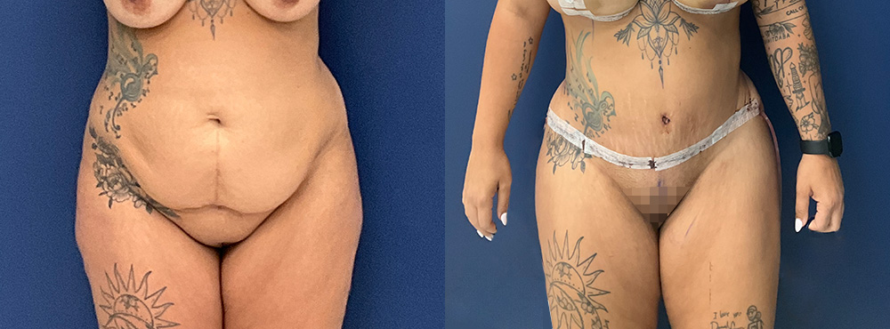Tummy Tuck Before and After