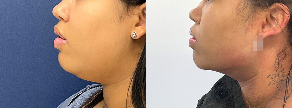 Chin Lipo Before and After in Miami