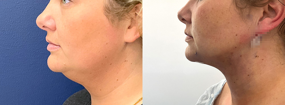 Chin Lipo Before and after