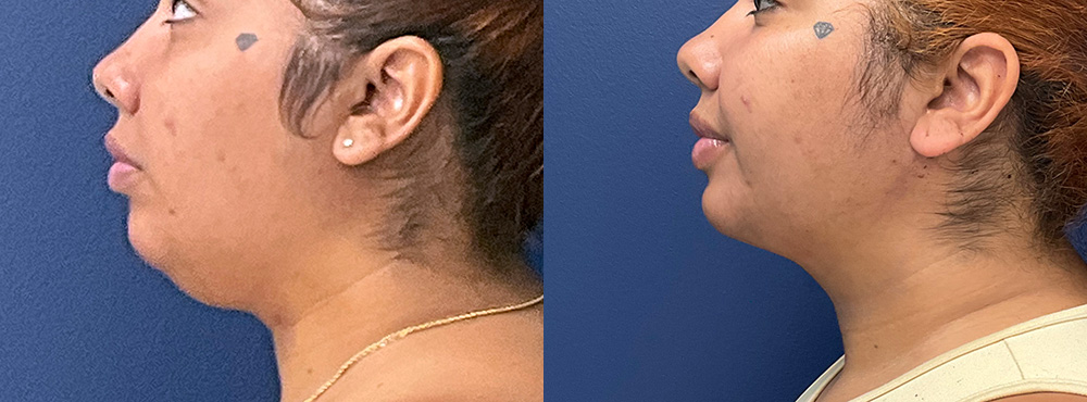 Chin Lipo Before and After